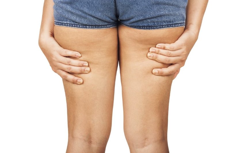 Causes of the appearance of cellulite