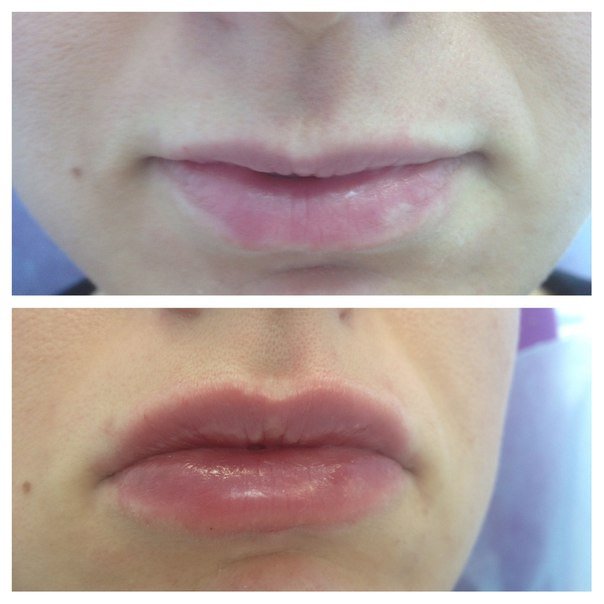 Lip augmentation with hyaluronic acid