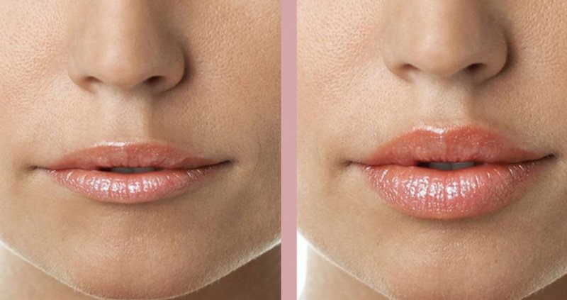 Lips before and after lip contouring with hyaluronic acid