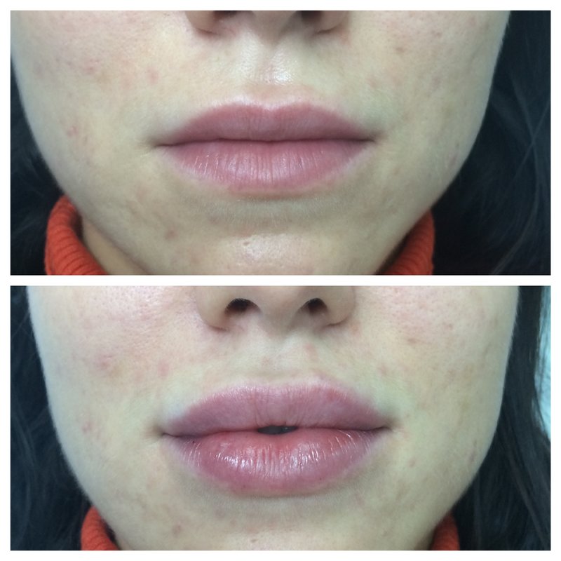 Lip augmentation with hyaluronic acid