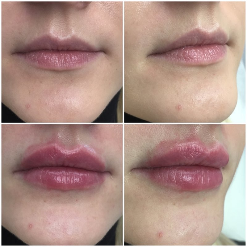 Lip augmentation with hyaluronic acid