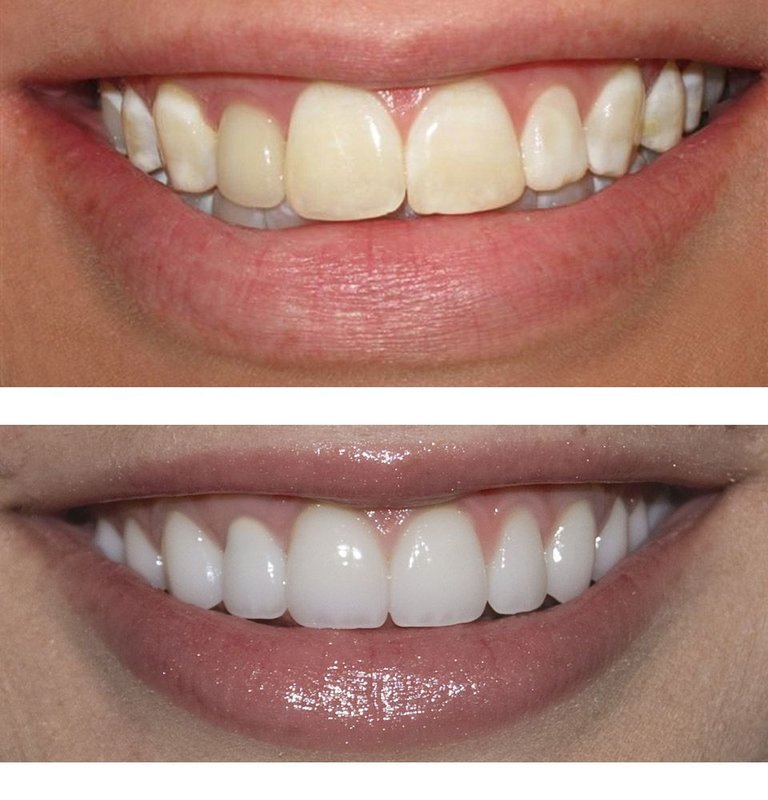 Perfect Smile Veneers: Before and After