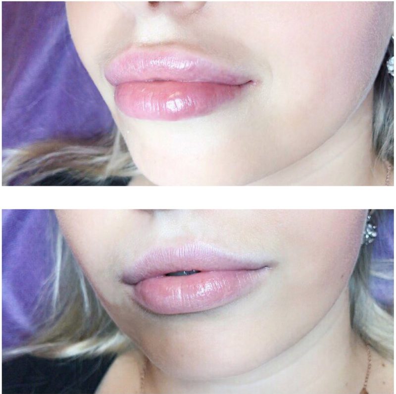 Lip swelling after hyaluronic acid enlargement