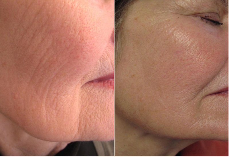 Treatment with Revi Brilliants: Before and After