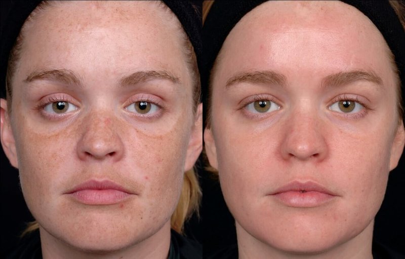 Before and after laser facial cleansing