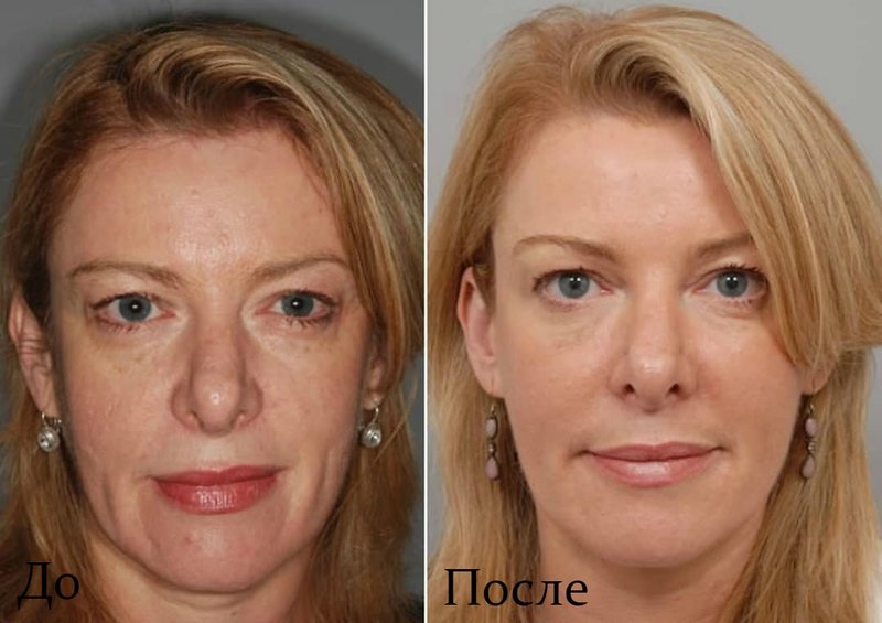 The result before and after the ultraformer lifting procedure