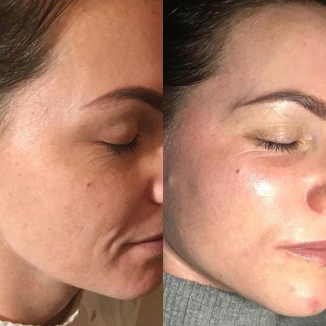 Prx-t33 peeling effect: before and after photos