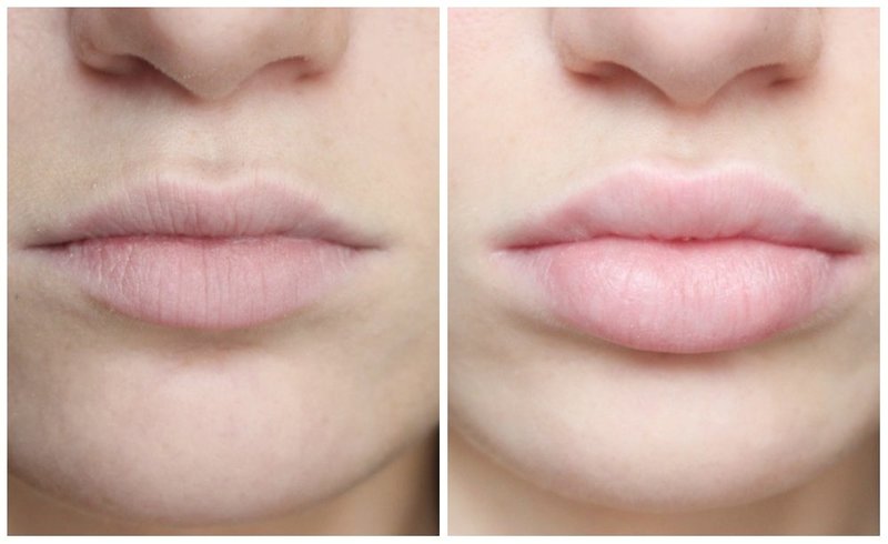 Lip augmentation with hyaluronic acid