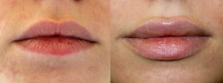 Lip augmentation with hyaluronic acid