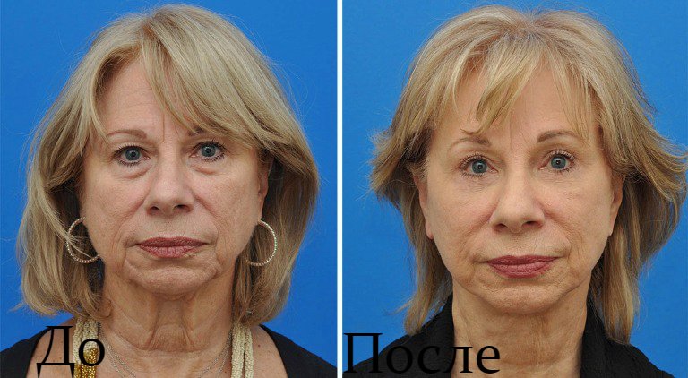 Ultrasonic lifting result: before and after