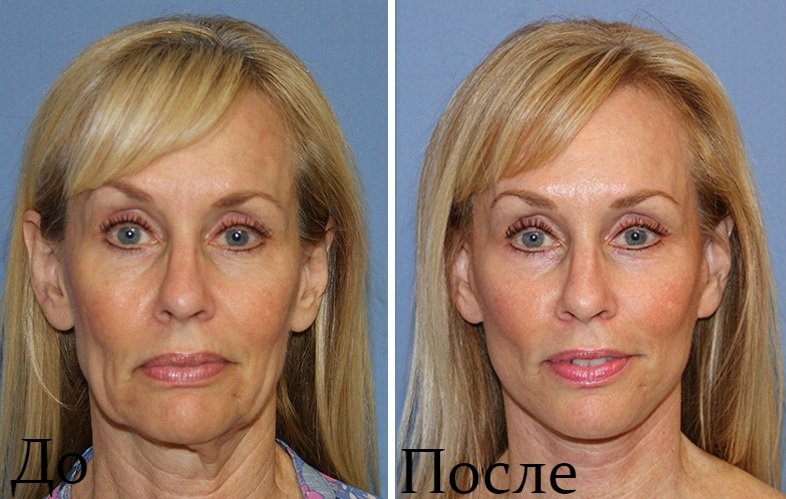 The result before and after the ultraformer lifting procedure