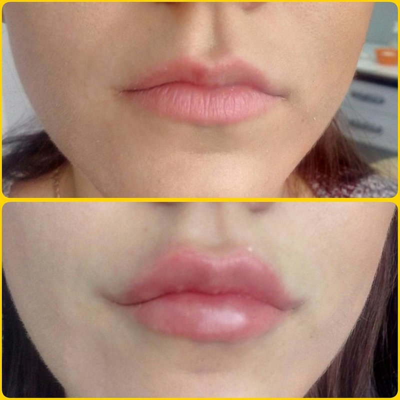 Lip augmentation with hyaluronic acid