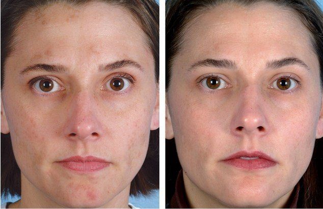 Before and after vacuum facial cleansing