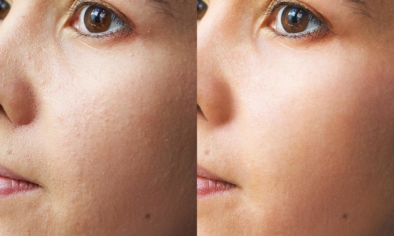 Before and after ultrasonic facial cleansing