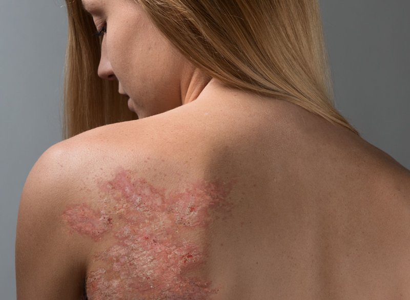 Psoriasis on the body