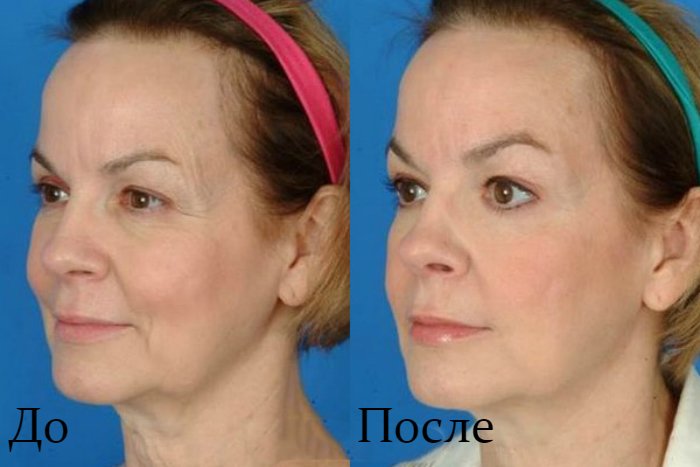 The result before and after the ultraformer lifting procedure