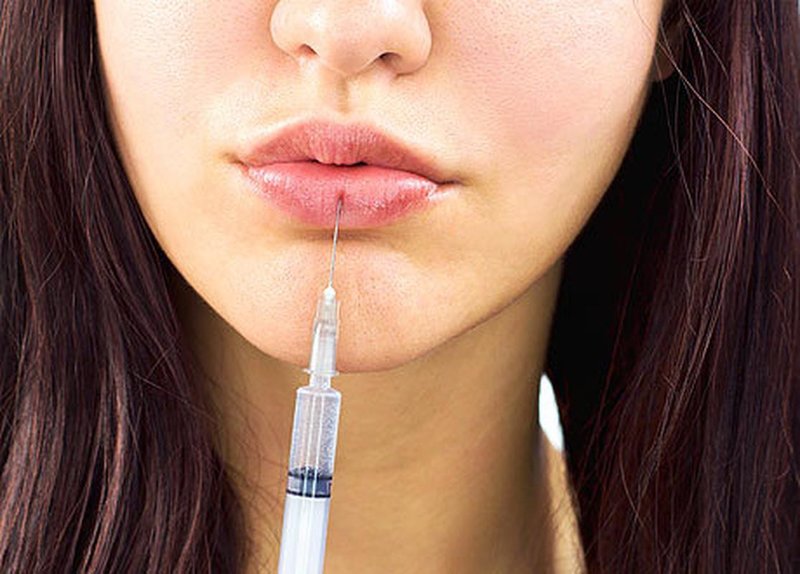 Hyaluronic Acid Injection