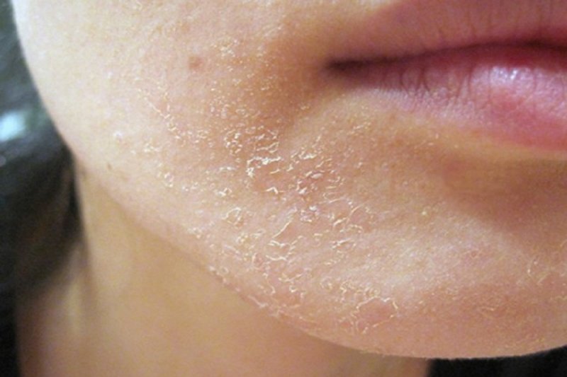 Why does skin peel?