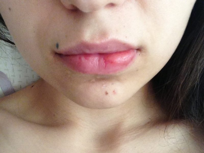 Lip ball after enlargement