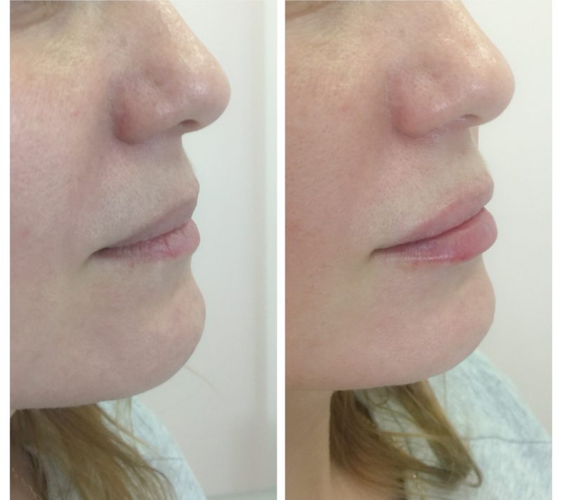 Lip augmentation with hyaluronic acid