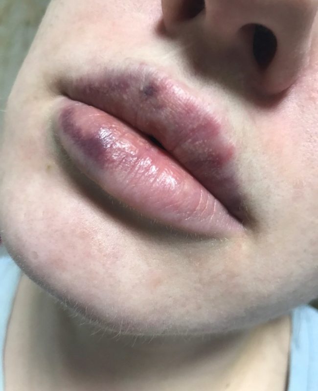 Bruises after lip augmentation