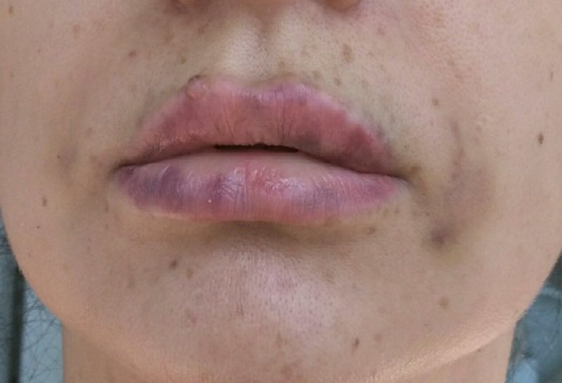 The consequences of unsuccessful lip augmentation