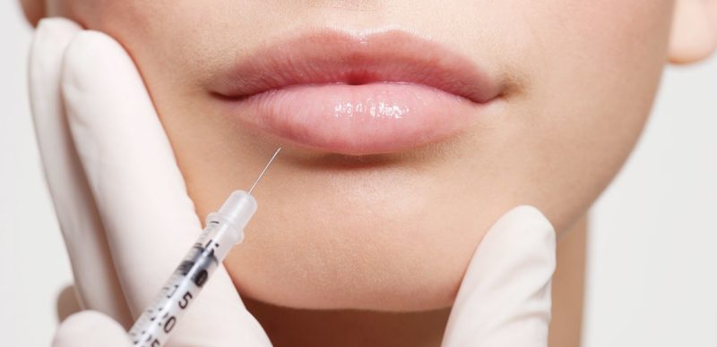 Hyaluronic acid injection in the lips