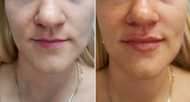 Lip augmentation with hyaluronic acid