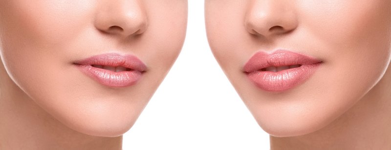 Lips enlarged fillers (before and after)