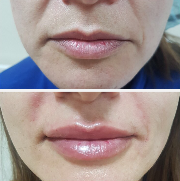 Lip augmentation with hyaluronic acid