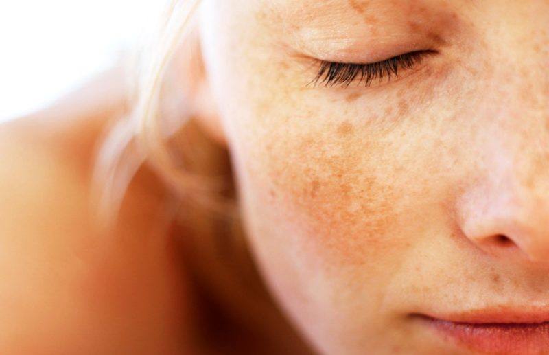 Girl with chloasma on her face.