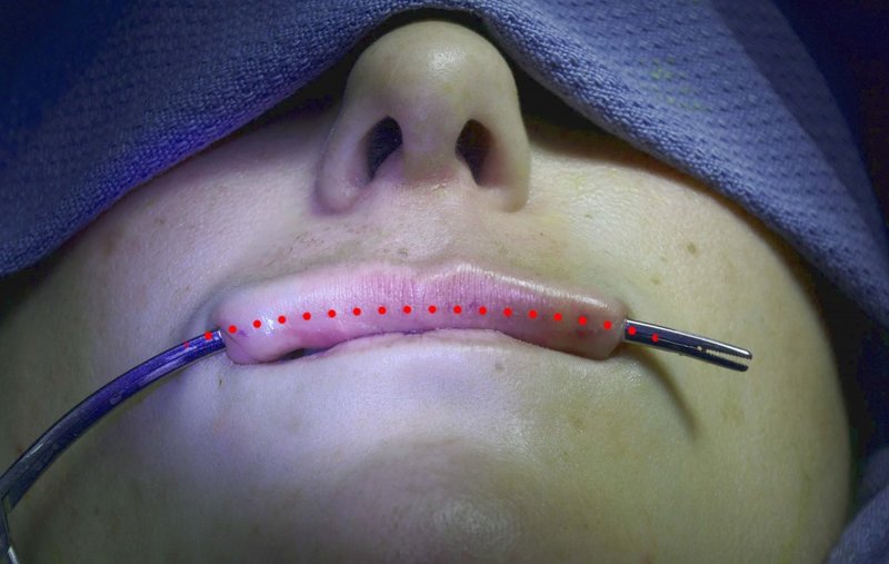 Installation of implants in the lips