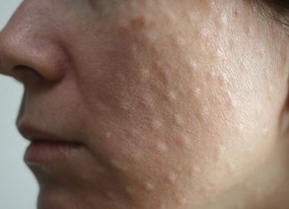 Papules after biorevitalization