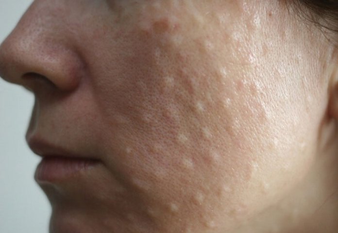 Papules after biorevitalization