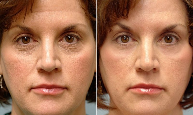 Face correction with RF lifting 10 procedures