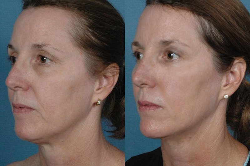 Correction of the chin and nasolabial folds with RF lifting 4 procedures