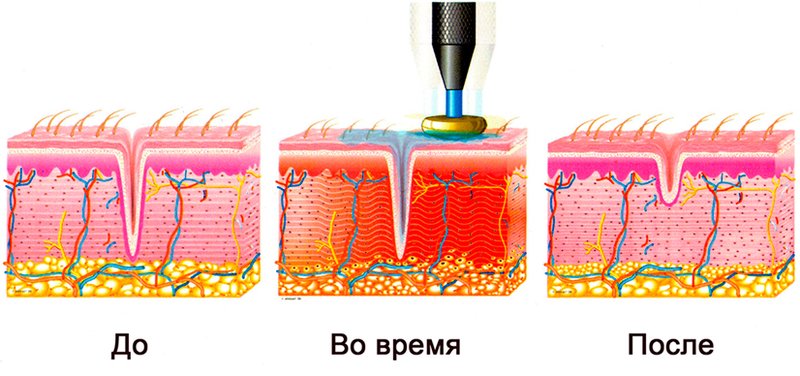 The mechanism of exposure to RF lifting