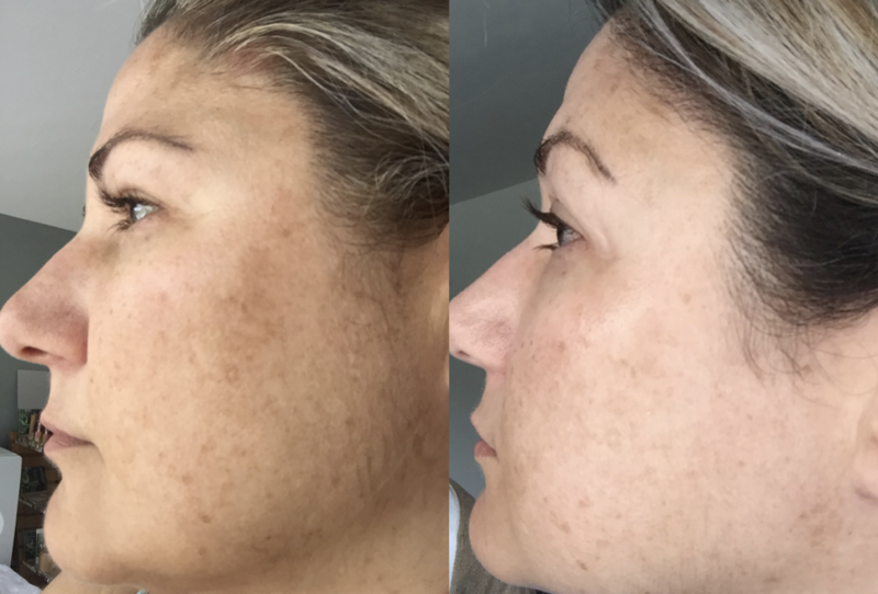 Peeling effect prx-t33: photo before and after four procedures