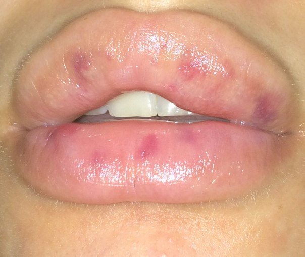 Bruises after lip augmentation