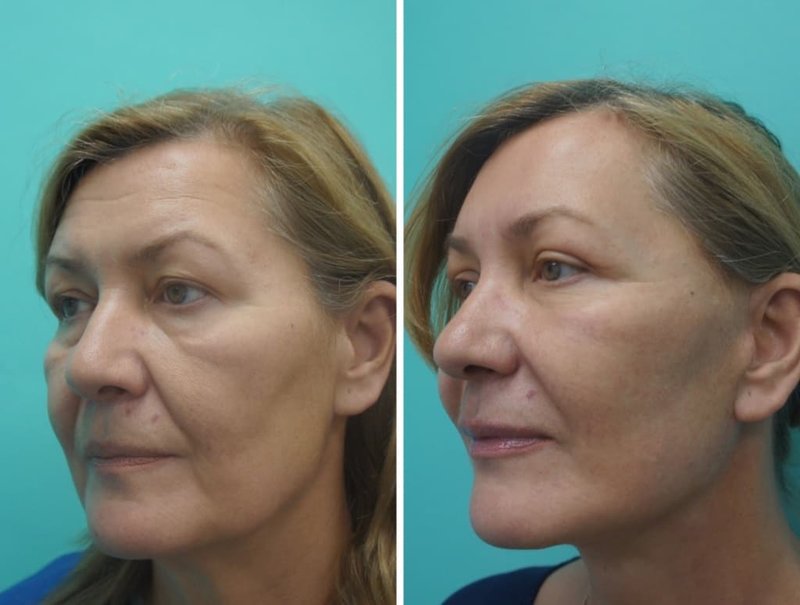 Hardware face and neck lift: review