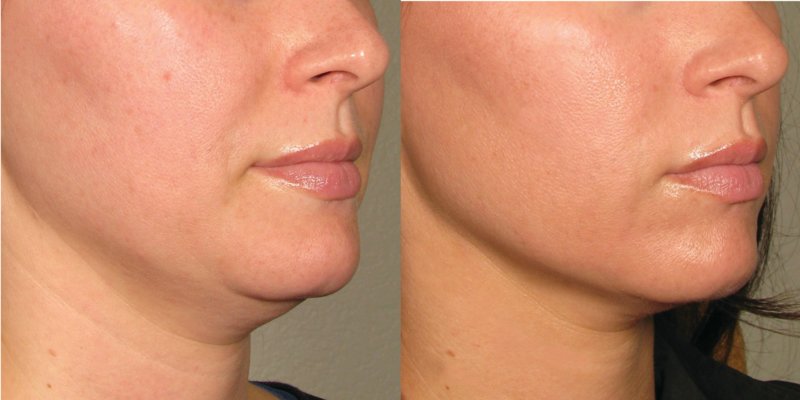 Facelift with hardware SMAS lifting