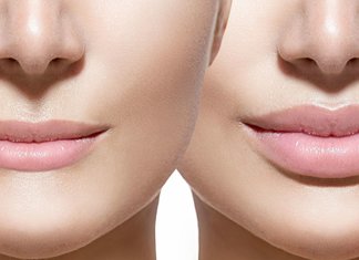 Lip augmentation: what will happen after the procedure?