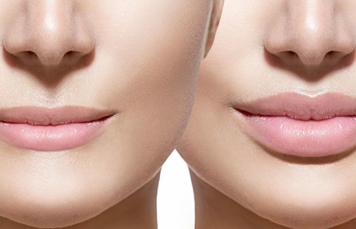 Lip augmentation: what will happen after the procedure?