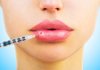 Lip augmentation with hyaluronic acid