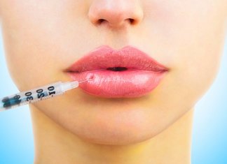 Lip augmentation with hyaluronic acid