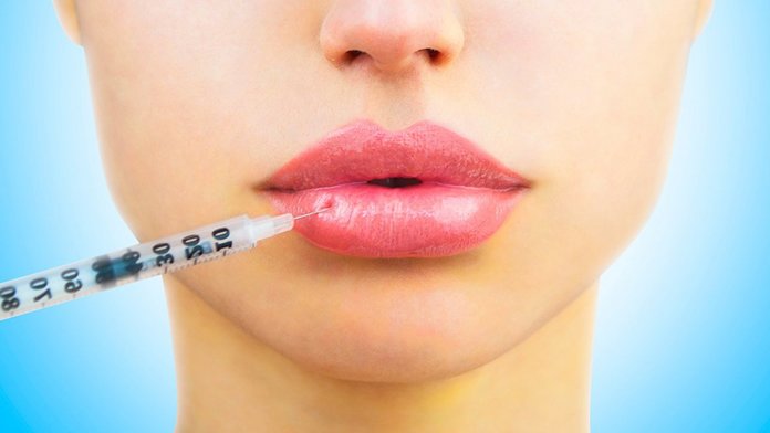 Lip augmentation with hyaluronic acid