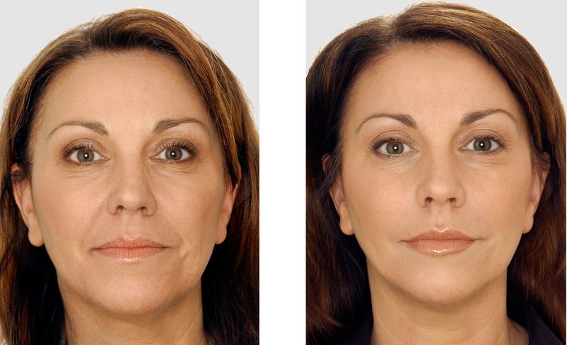 Rejuvenation of the nasolabial folds