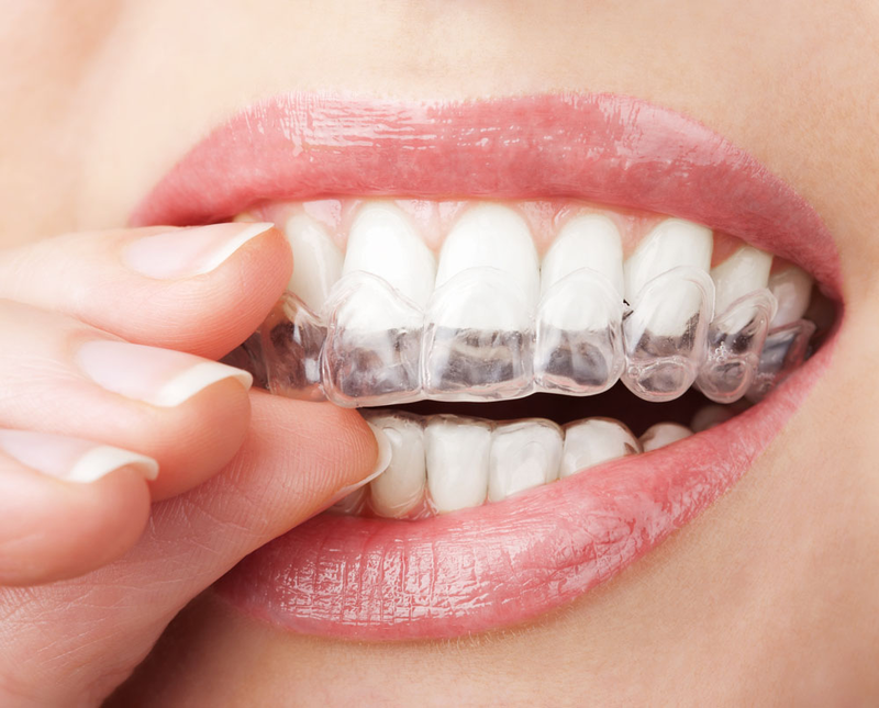 Teeth Whitening Mouthguards