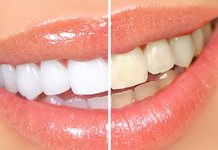 Teeth Whitening at Home