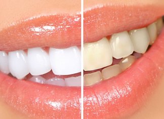 Teeth Whitening at Home